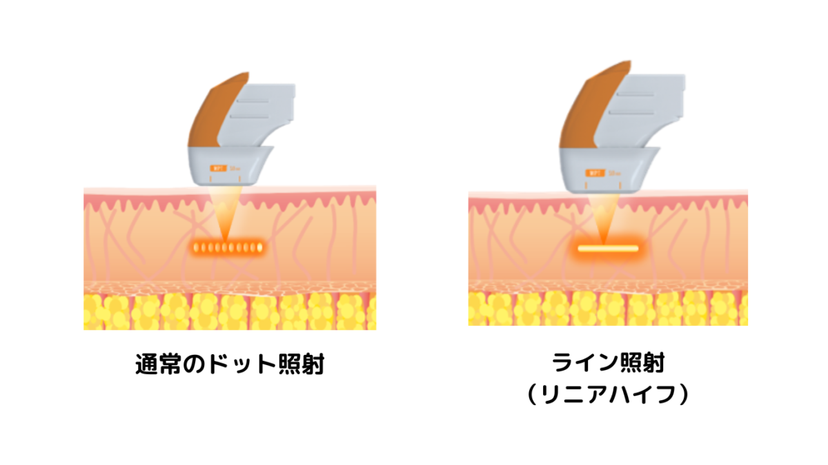 リニアハイフ